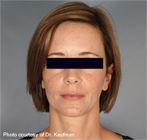 facial wrinkles after ActiveFX