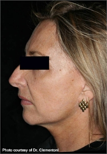 Wrinkles pigmented skin after ActiveFX