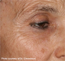 periorbital wrinkles before ActiveFX