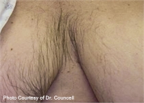 unwanted chest hair before laser hair removal