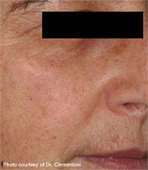 Keratosis brown spots after laser treatment