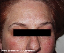 Mottled skin pigment after laser therapy