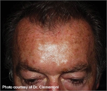 Pigmented skin before laser treatment
