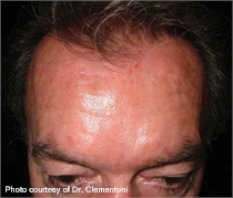 Pigmented skin after laser treatment